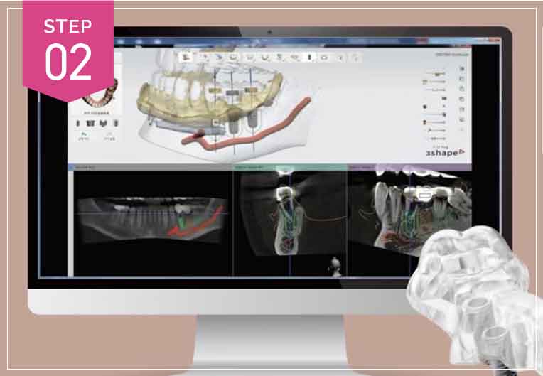 インプラント埋め込みのシミュレーション