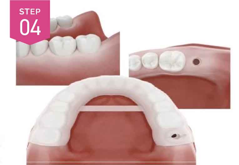 インプラント埋入