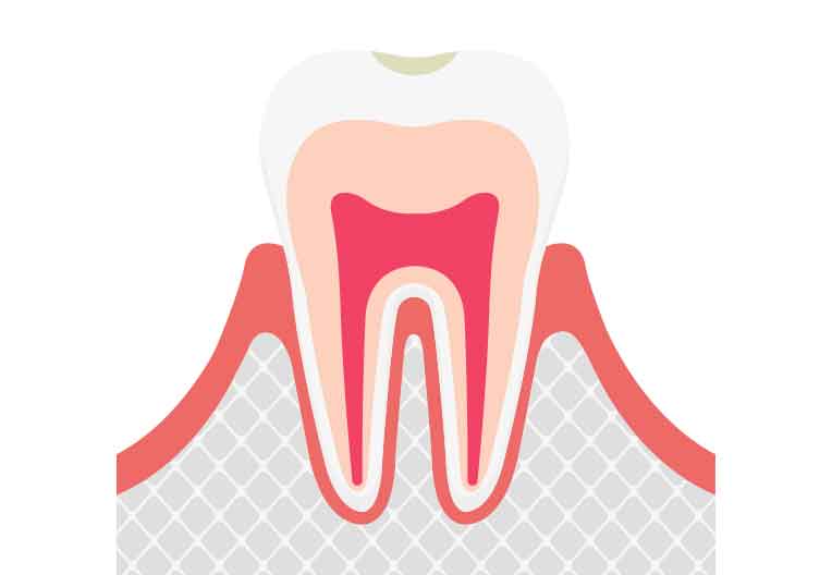 CO(シーオー):初期虫歯