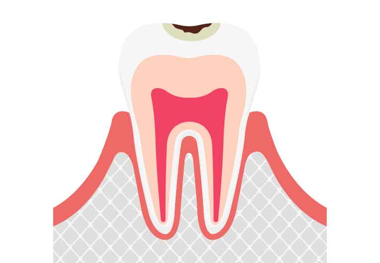 C1: エナメル質の虫歯