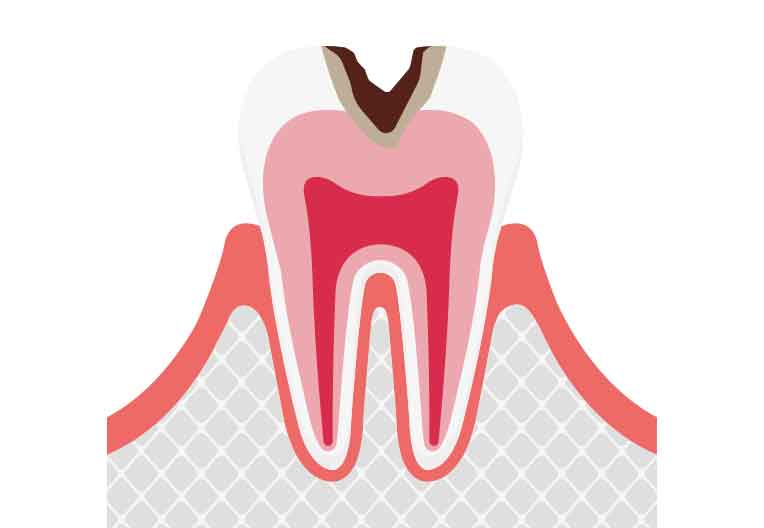 C2: 象牙質の虫歯