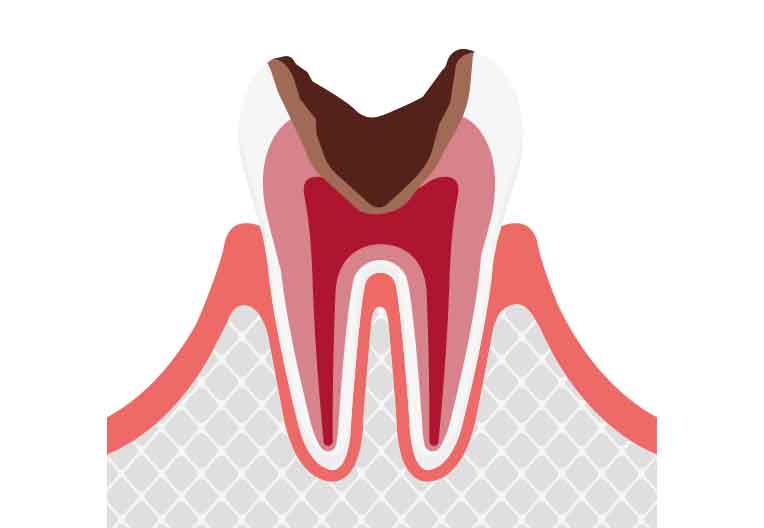 C3: 神経に及ぶ虫歯