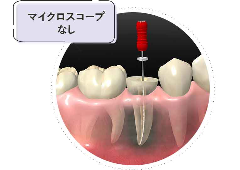 マイクロスコープを使わない根管治療の場合