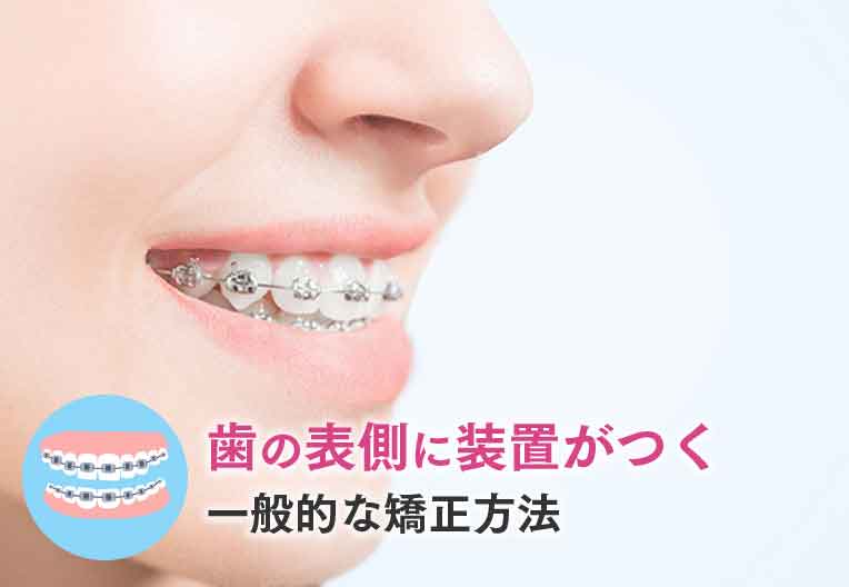 唇側矯正(表側矯正)