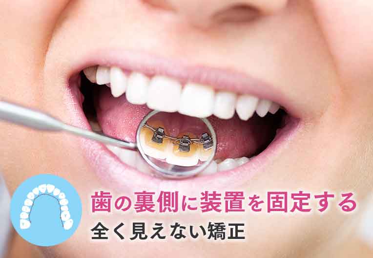 舌側矯正(裏側矯正)