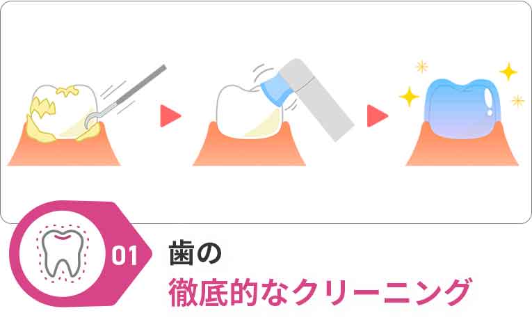 PMTC(クリーニング)