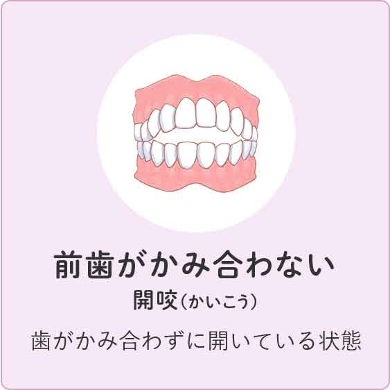 前歯がかみ合わない 歯がかみ合わずに開いている状態