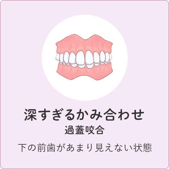 深すぎるかみ合わせ 下の前歯があまり見えない状態