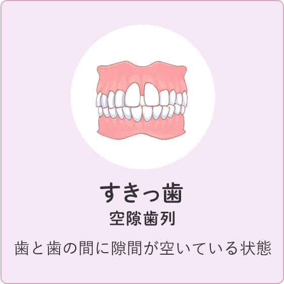 すきっ歯 歯と歯の間に隙間が空いている状態